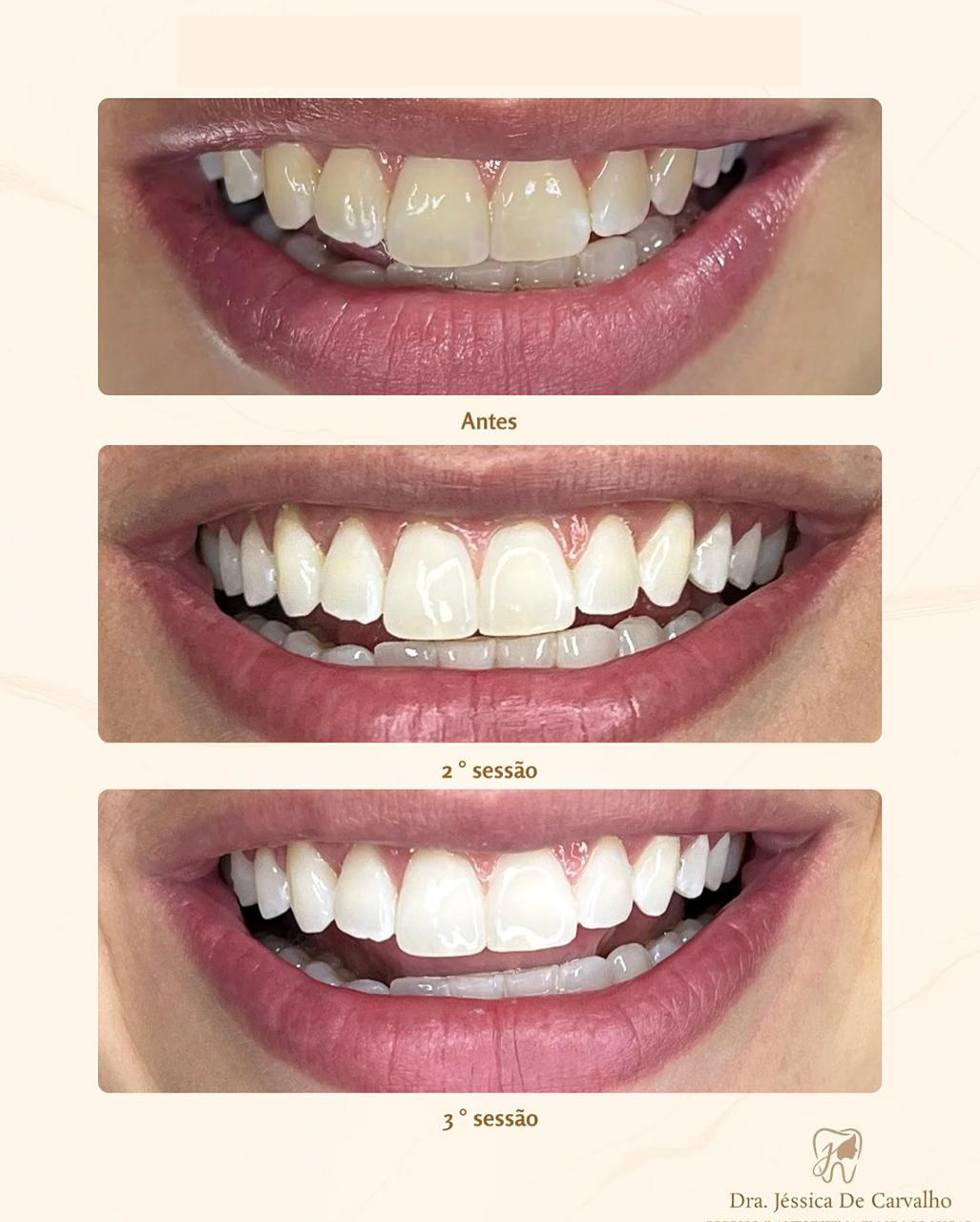 Clareamento Dental