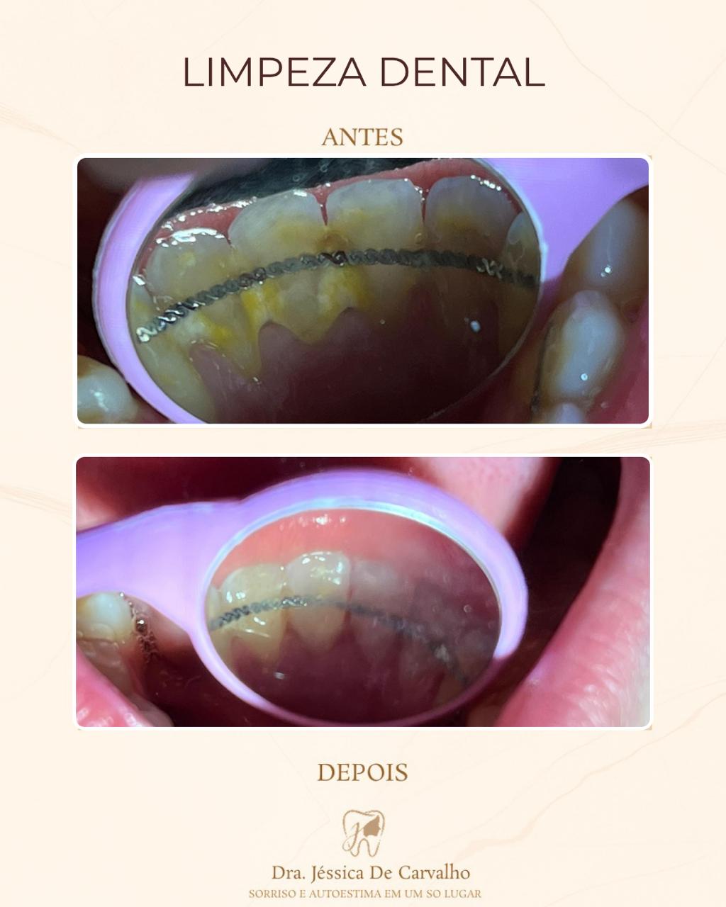 Limpeza Dental