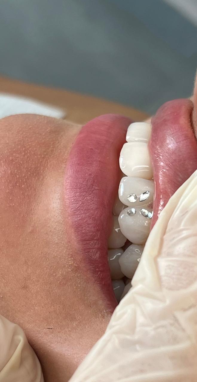 Piercing Dental