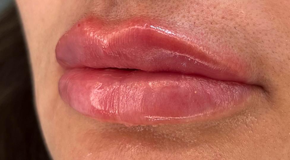 Preenchimento Labial