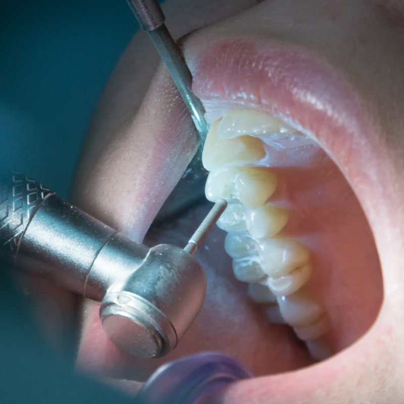 Restauração Dental
